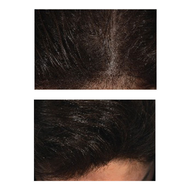 Before and after images of neuHair product usage
